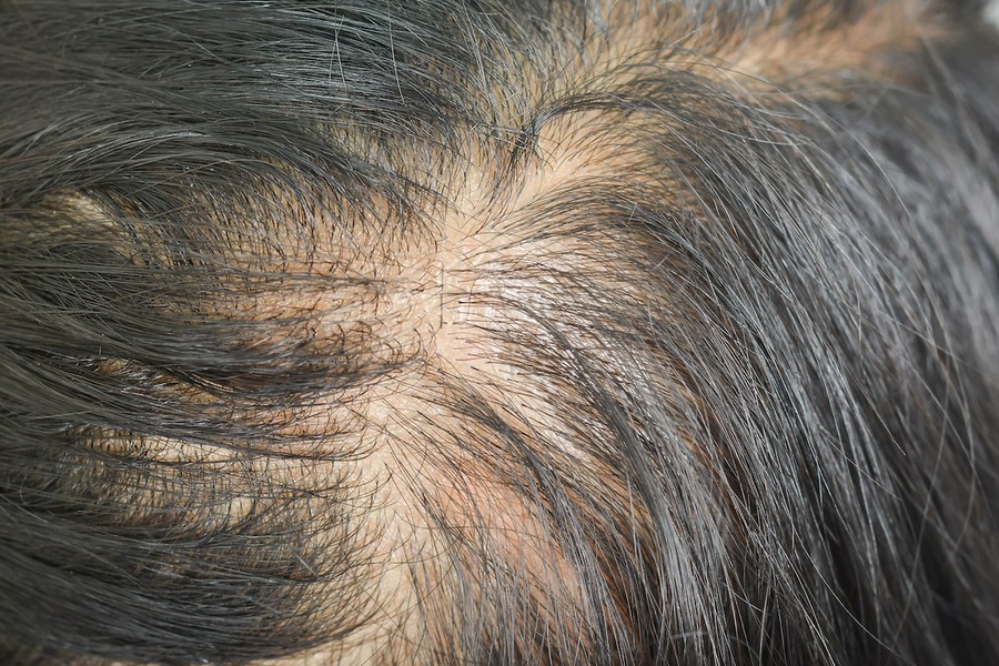 Diffuse Thinning: Signs, Symptoms, And Treatment Options