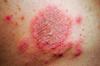 Discoid eczema