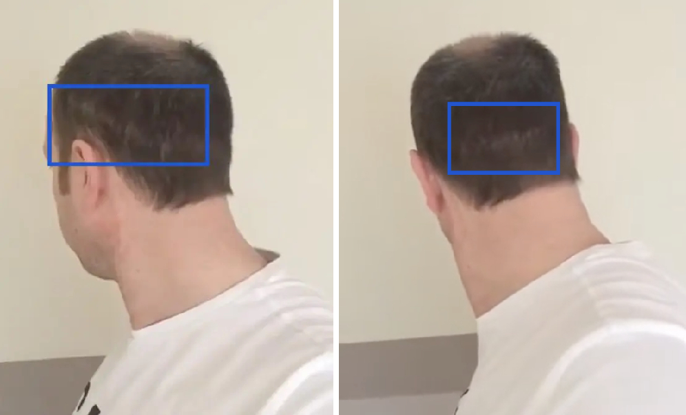 Donor area 1 month after hair transplant