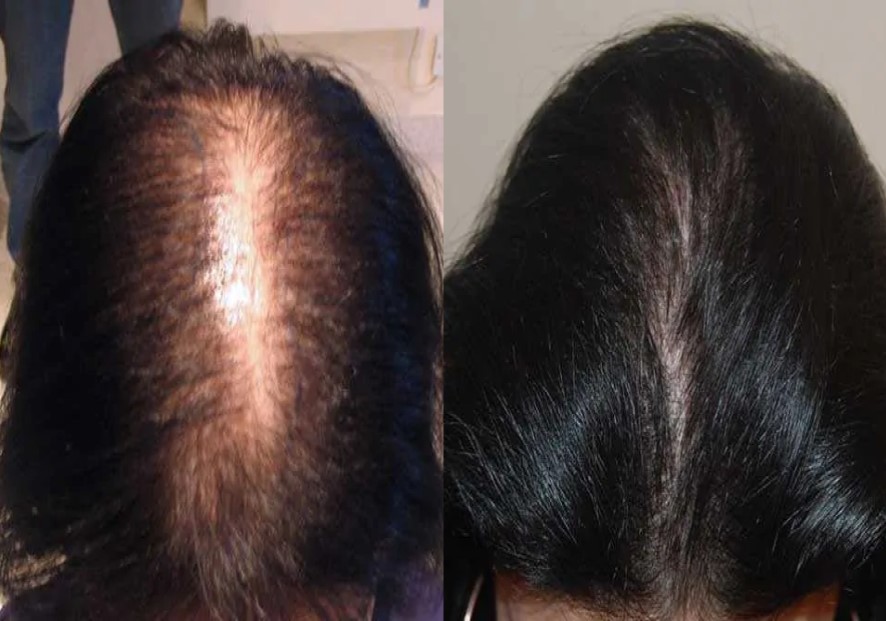 Before and after 1500 grafts FUT hair transplant