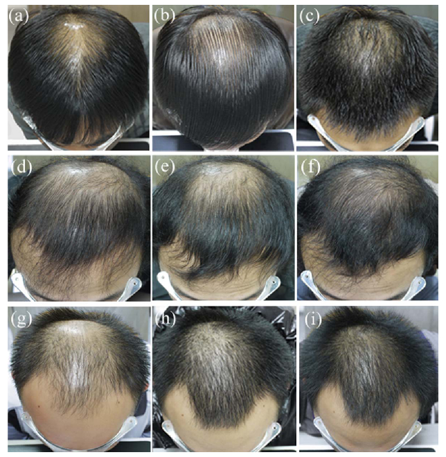 Patient before and after Minoxidil and Finasteride