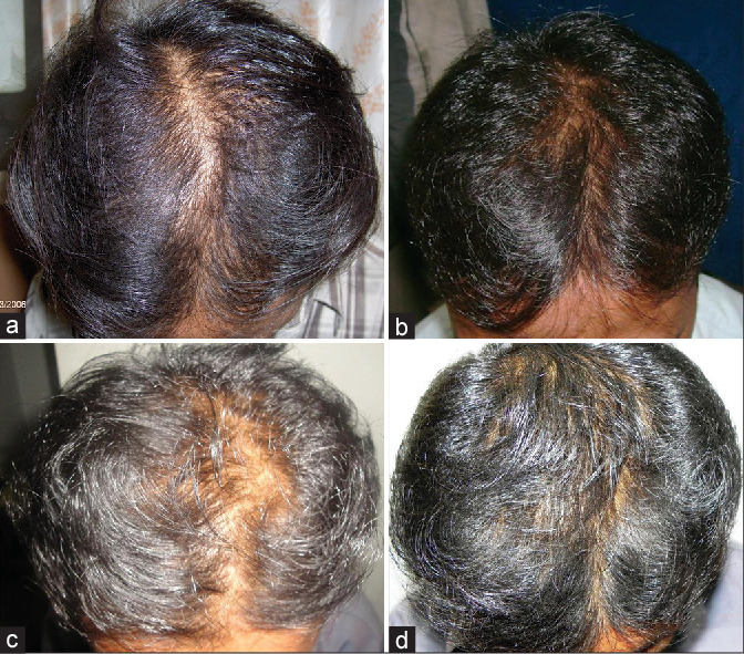 Patient before and after Minoxidil and Finasteride