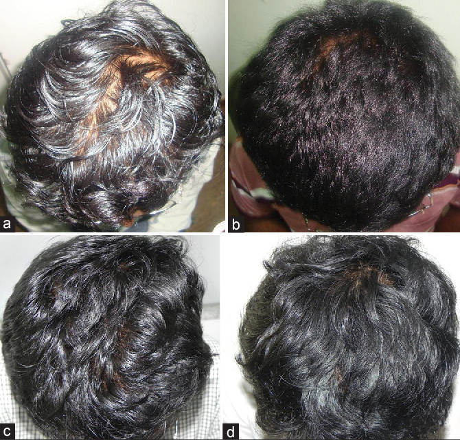 Patient before and after Minoxidil fortified with Finasteride