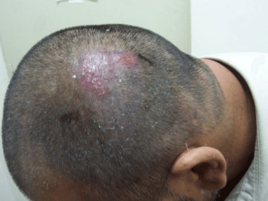 folliculitis after hair transplant featured image