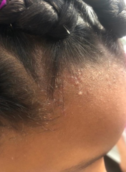 Folliculitis in traction alopecia