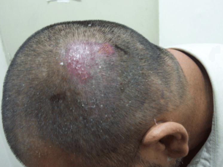 Folliculitis