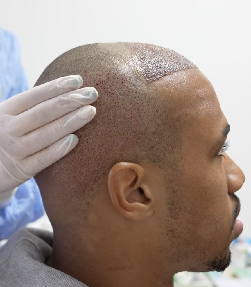 Gabriel Magalhaes hair transplant