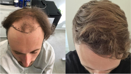 before and after hair transplant