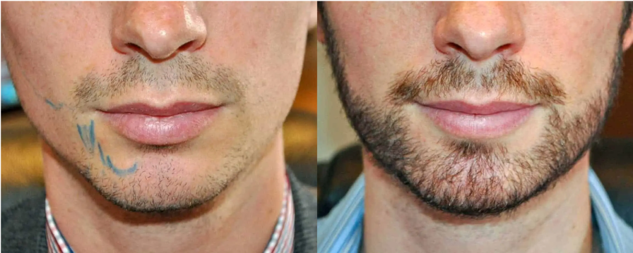 Beard Transplant, Wimpole Clinic