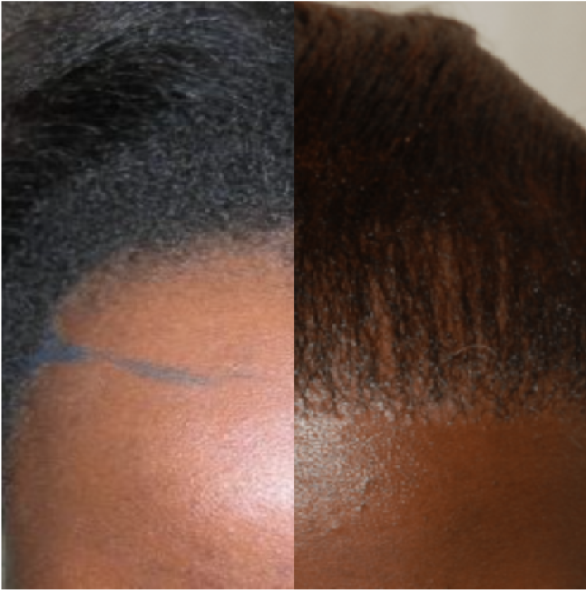 FUT Hair Transplant, Wimpole Clinic