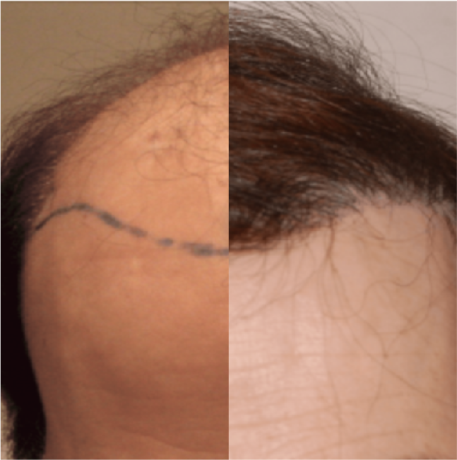 FUT Hair Transplant, Wimpole Clinic