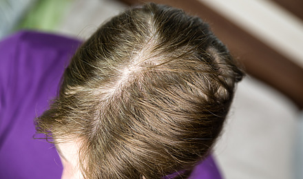 My Hair Is So Thin I Can See My Scalp: What Should You Do?