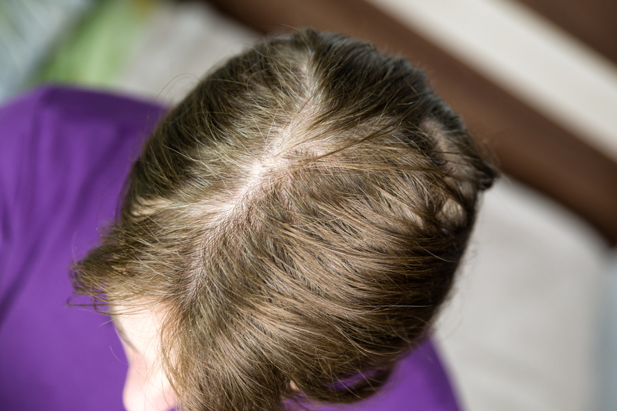 My Hair Is So Thin I Can See My Scalp: What Should You Do?