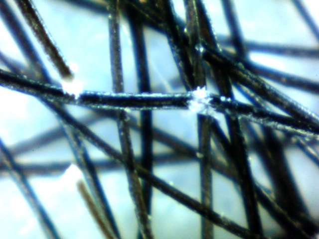 Hair shaft with trichorrhexis nodosa