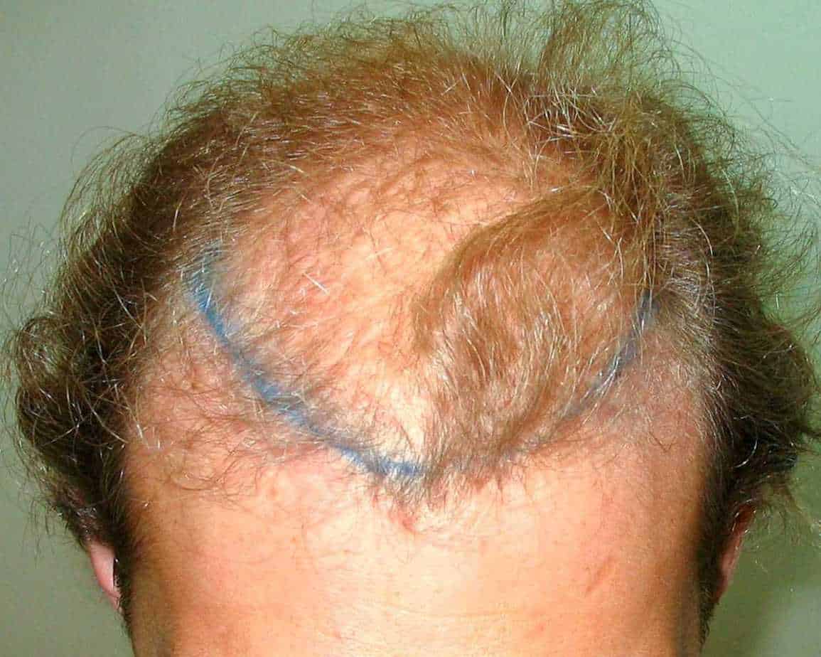 before hair transplant