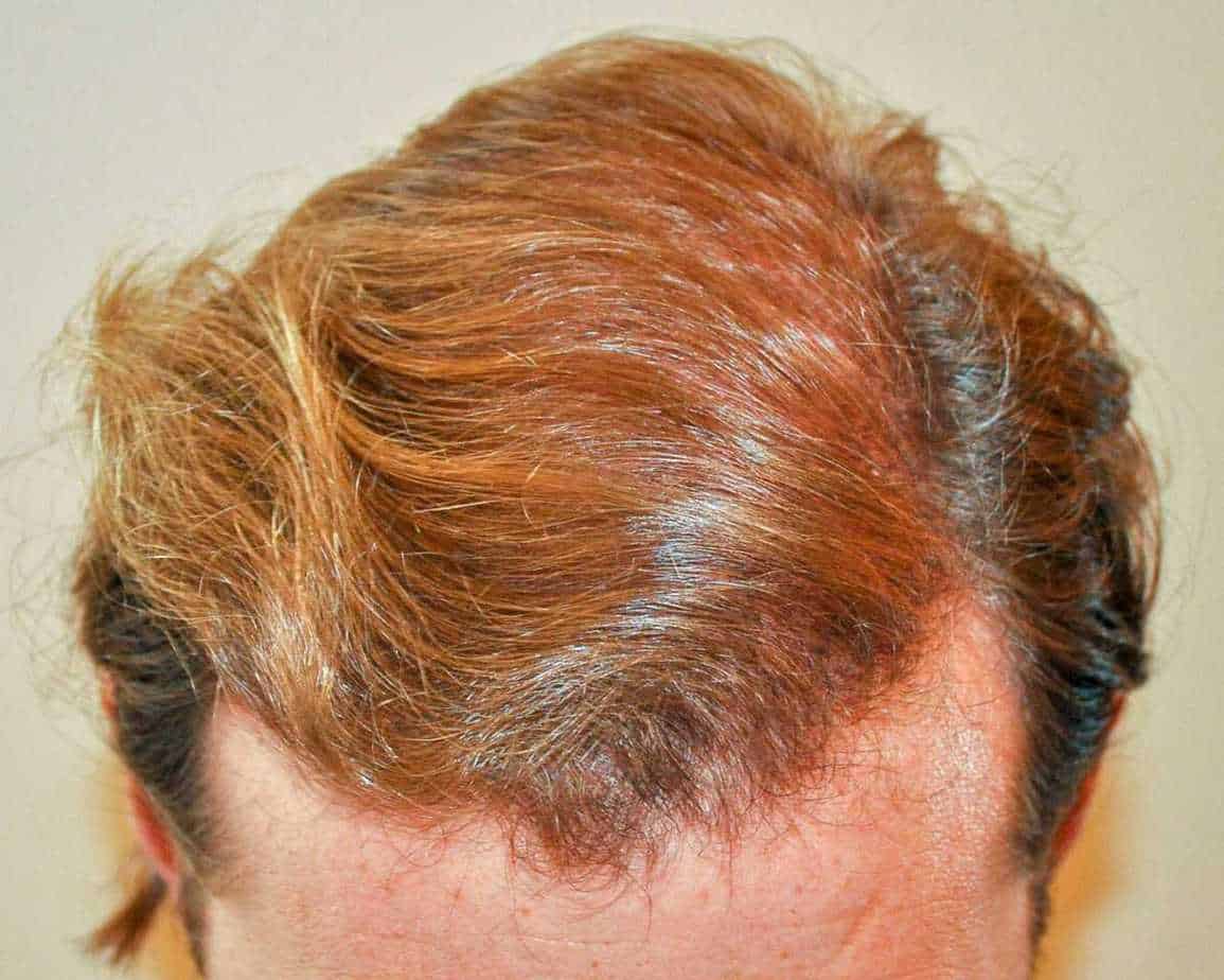 after hair transplant results