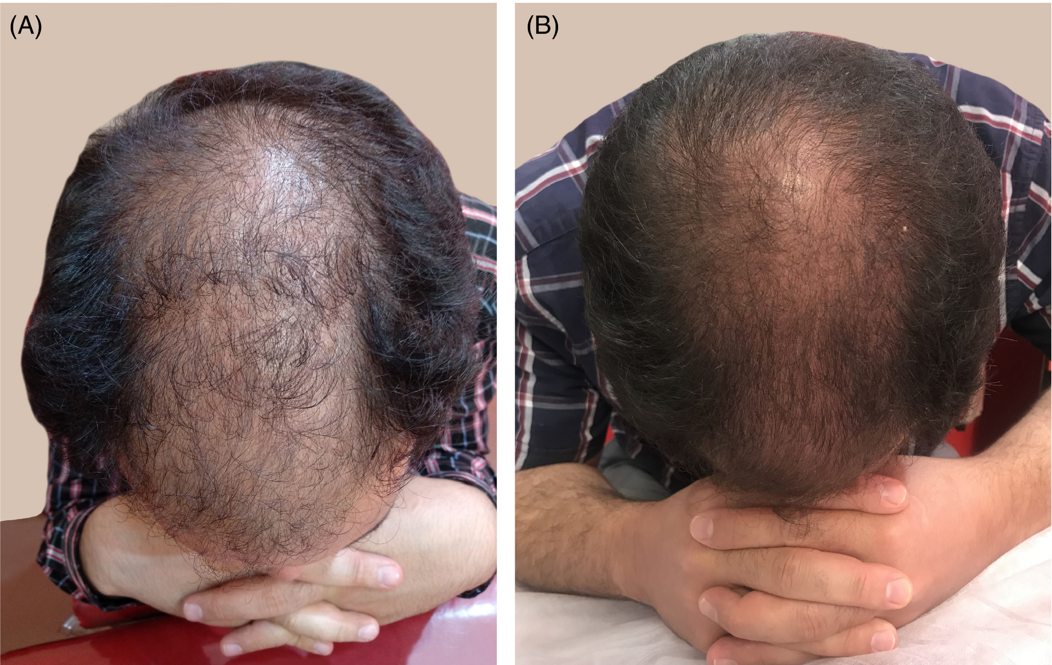 Images comparing a 1.2mm micro-needling treatment (A) with 0.6mm micro-needling treatment.