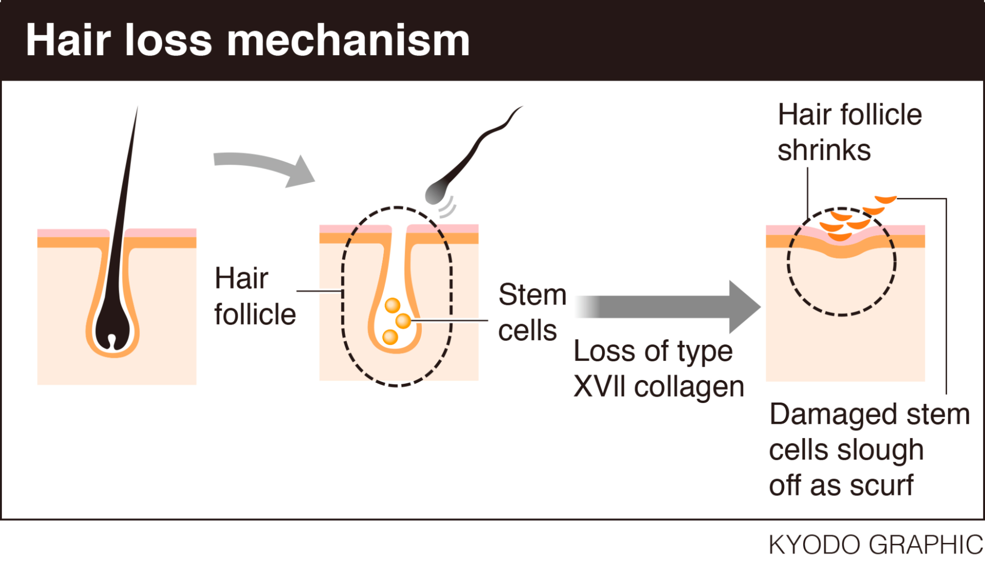 Informational graphic showing the effect loss of collagen has on hair