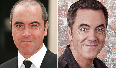 James Nesbitt Before & After Hair Transplant