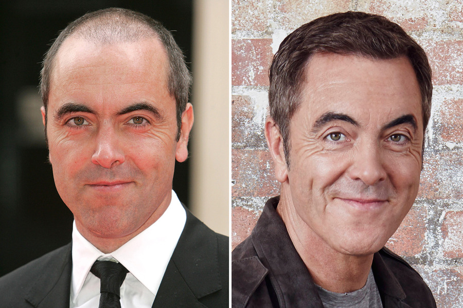 James Nesbitt Before & After Hair Transplant