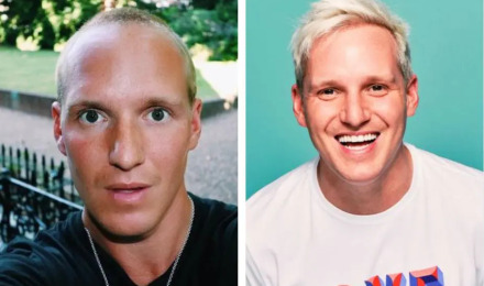 Jamie Laing Hair Transplant: Everything You Need To Know