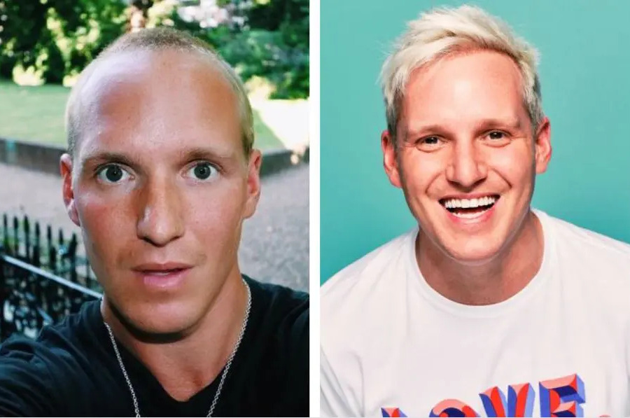 Jamie Laing Hair Transplant: Everything You Need To Know