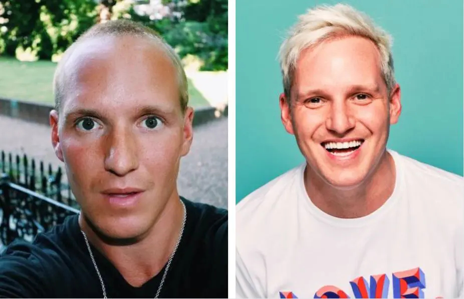 Jamie Laing Hair Transplant: Everything You Need To Know