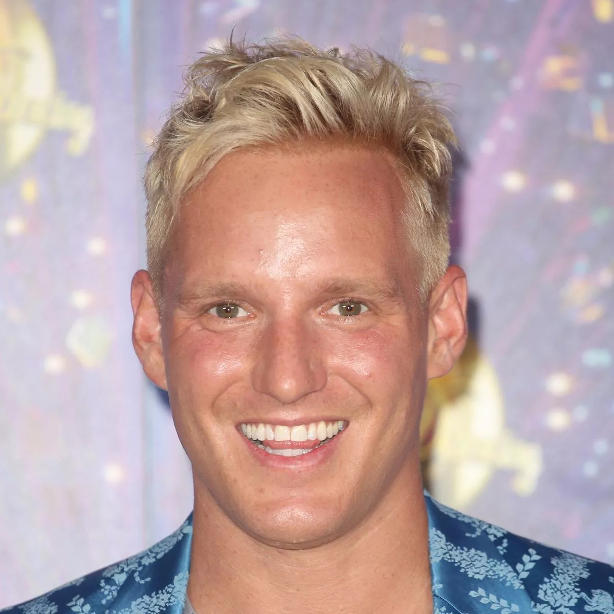 Jamie Laing post hair transplant