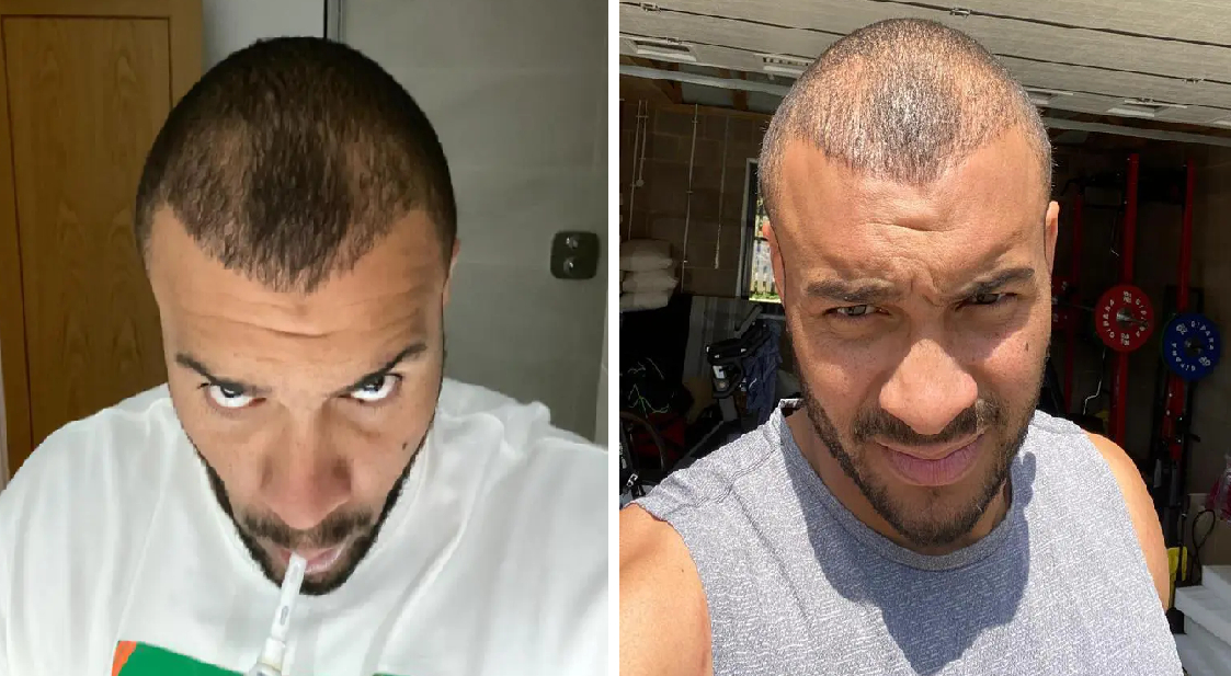 Jonathan Joseph 4-6 months post hair transplant