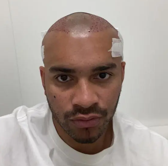 Jonathan Joseph post hair transplant