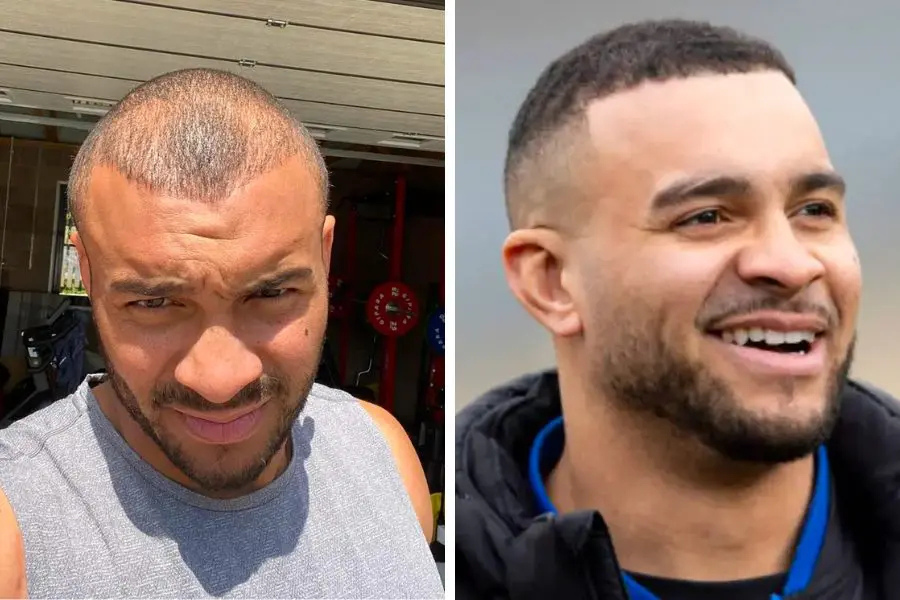 Jonathan Joseph before and after his FUE hair transplant surgery