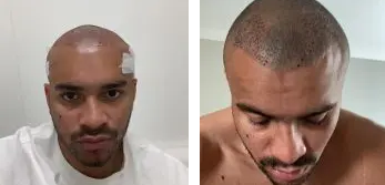 Jonathan Joseph immediately after surgery and 2 days after hair transplant