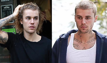 Justin Bieber Hair Transplant