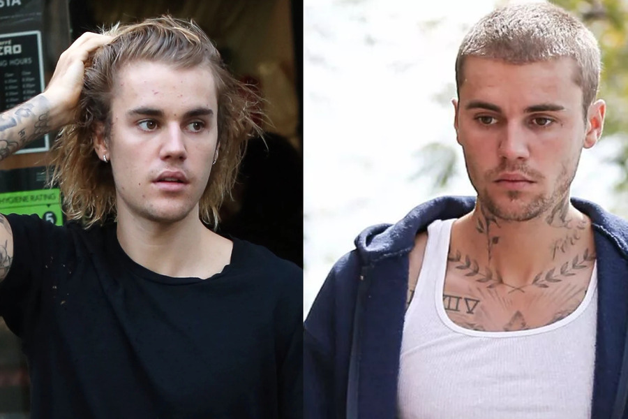 Justin Bieber Hair Transplant