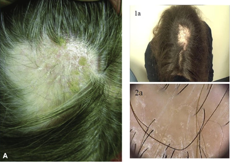 Lichen planopilaris in the scalp resutling in hair loss due to itching