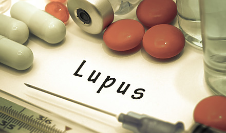 Lupus And Hair Loss: Causes, Symptoms, Diagnosis & Treatment