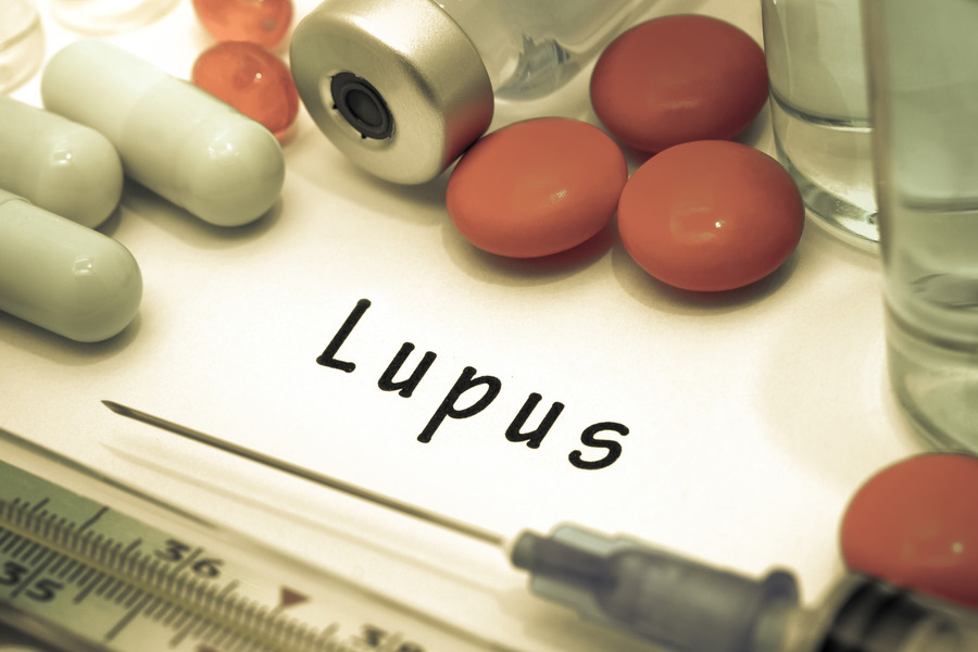 Lupus And Hair Loss: Causes, Symptoms, Diagnosis & Treatment