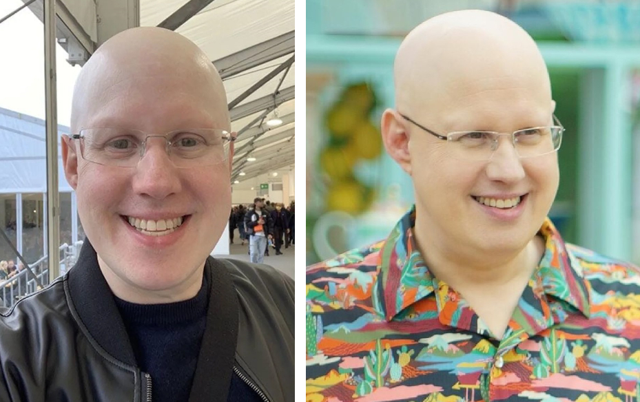 Matt Lucas Alopecia: Everything You Need To Know