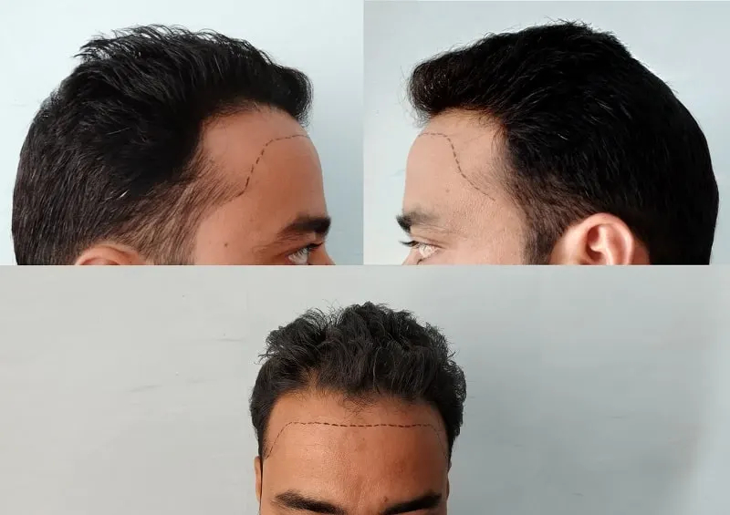 How To Fix A Messed Up Hairline