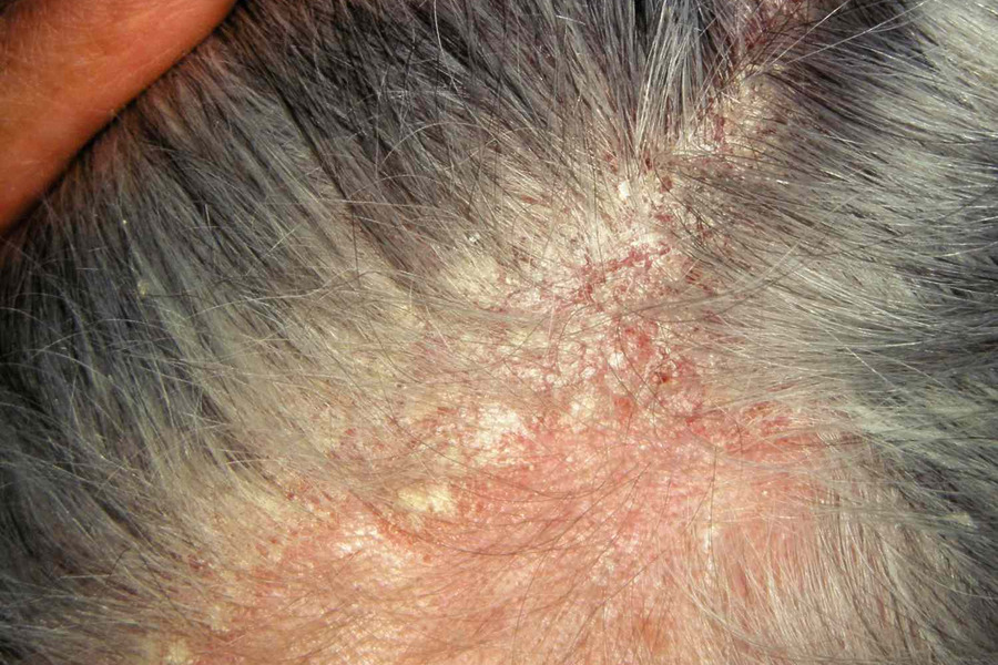 NHS Seborrheic Dermatitis Featured Image