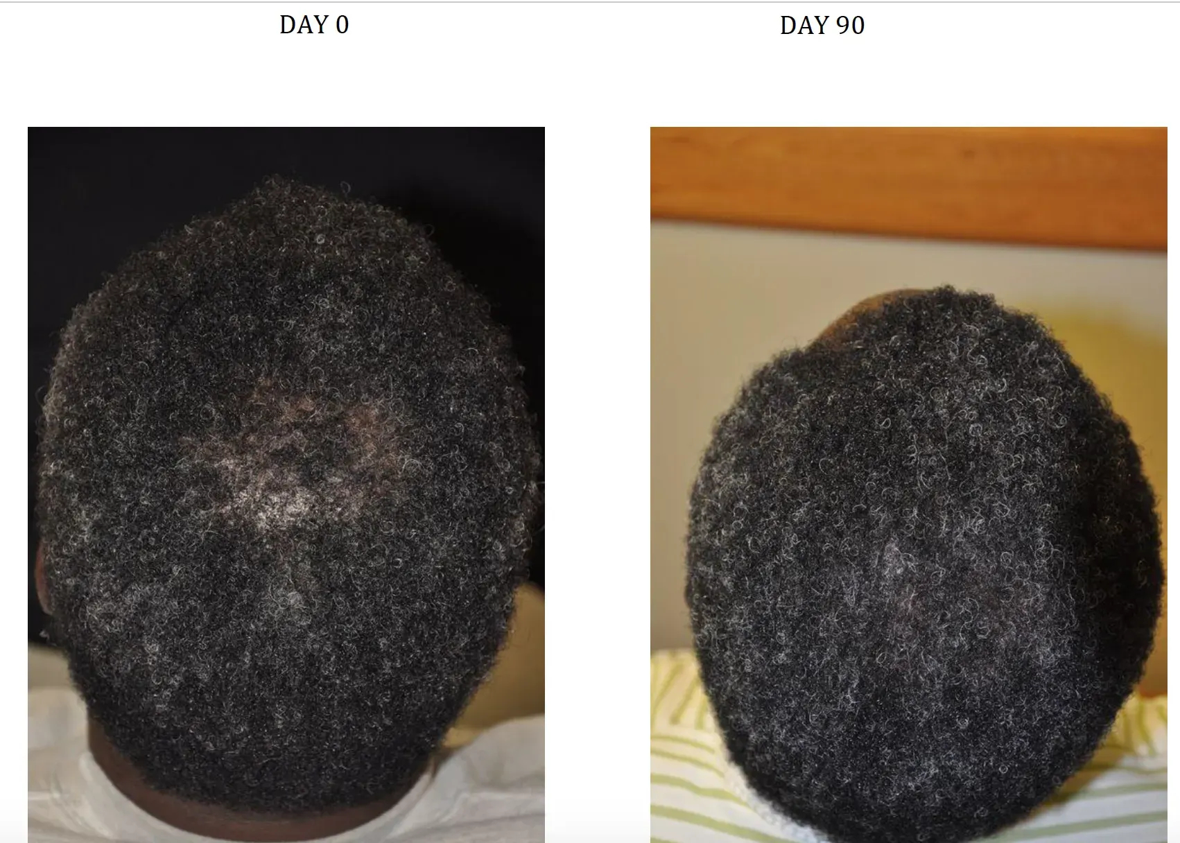 Hair growth results from taking Nanoxidil for 90 days