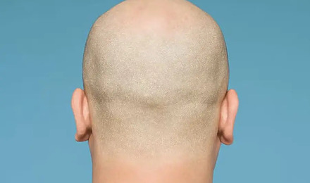 8000 Grafts Hair Transplant: Coverage, Results, Costs