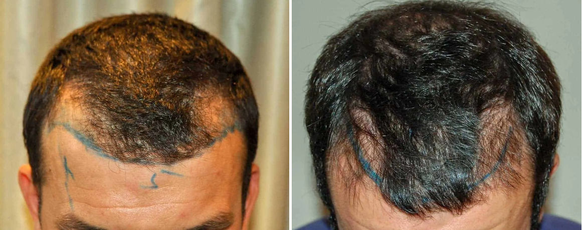 Norwood stage 4 hair loss