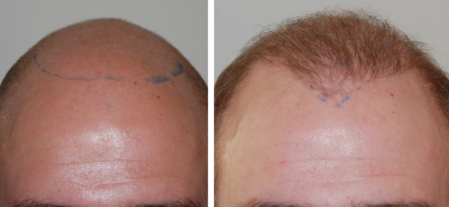 Patient before and 6 months after hair transplant