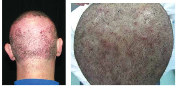 Patient examples of folliculitis