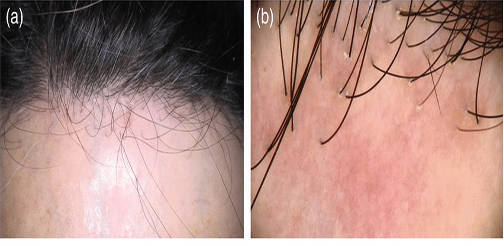 Perifollicular erythema and scaling