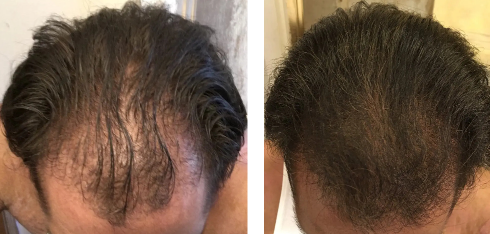 Results from taking Finasteride for 9 months