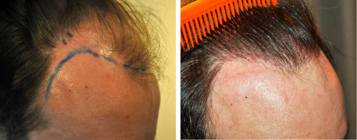 Results shown 12 months after FUE hair transplant procedure.