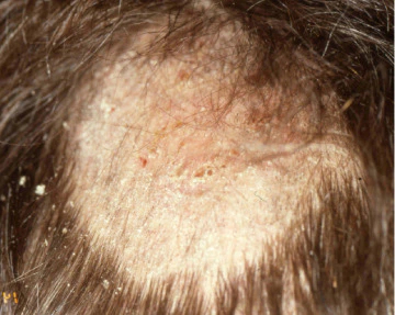 Ringworm on the scalp