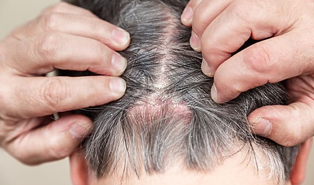 Scalp Psoriasis